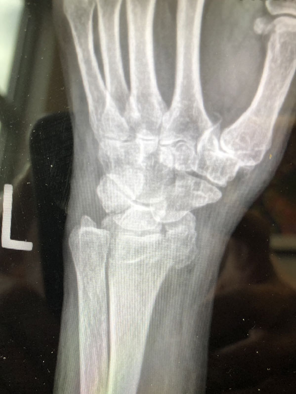 Distal Radial Fracture