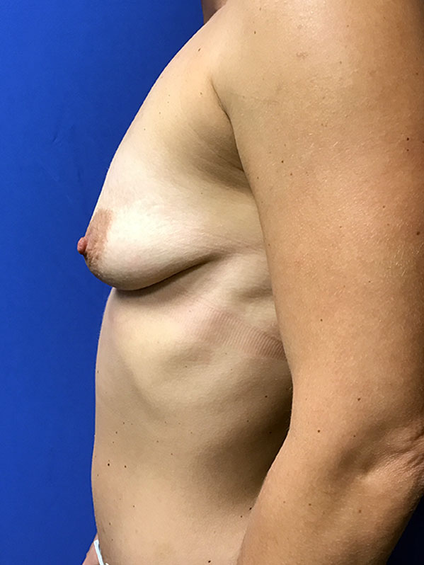Breast Augmentation Orlando - Before
