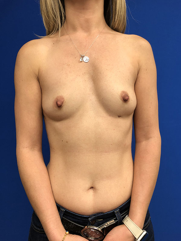 Breast Augmentation Orlando - Before